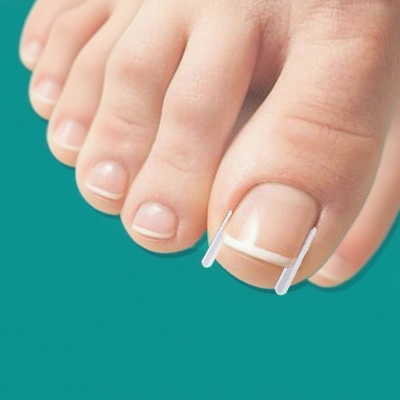 Ingrown Toenail Treatment Corrector Set
