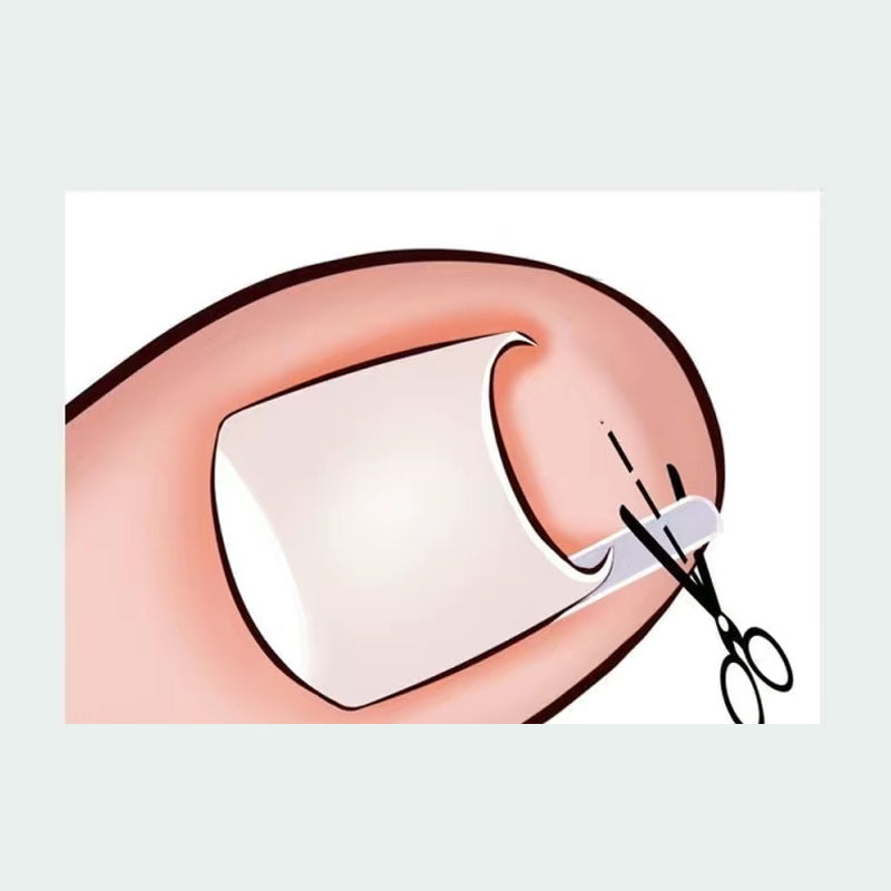 Ingrown Toenail Treatment Corrector Set